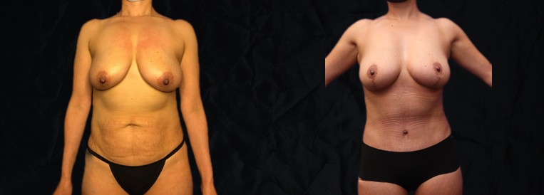 PT 7628 Breast Augmentation Scottsdale