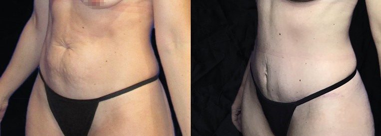 PT 7712-1 Breast Augmentation Scottsdale