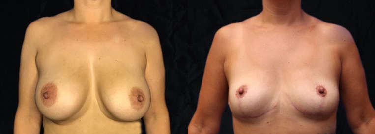 PT 9080 Breast Augmentation Scottsdale