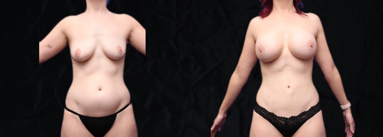 PT 9719 Breast Augmentation Scottsdale
