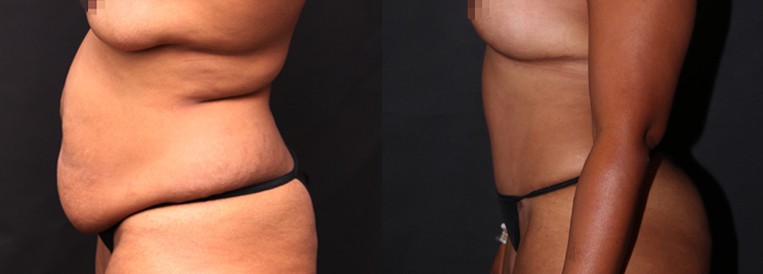 PT 9819-1 Breast Augmentation Scottsdale