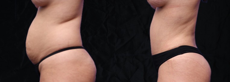 PT 9927-1 Breast Augmentation Scottsdale