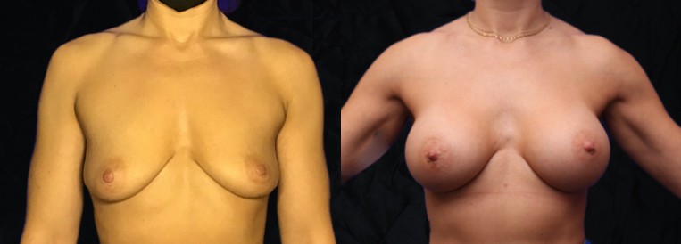 beforenafter pt 5815 Breast Augmentation Scottsdale