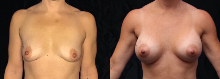 beforenafter pt 7462 Breast Augmentation Scottsdale