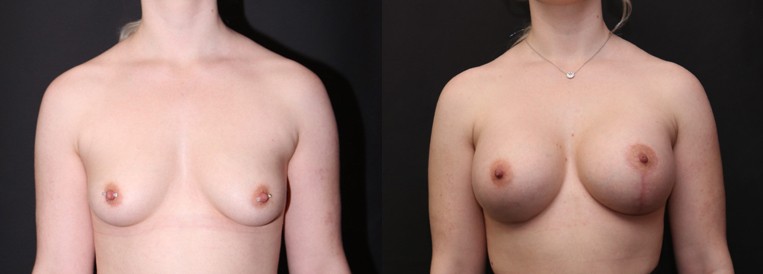 beforenafter pt 8031 Breast Augmentation Scottsdale