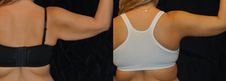 beforenafter pt1694-2 Breast Augmentation Scottsdale