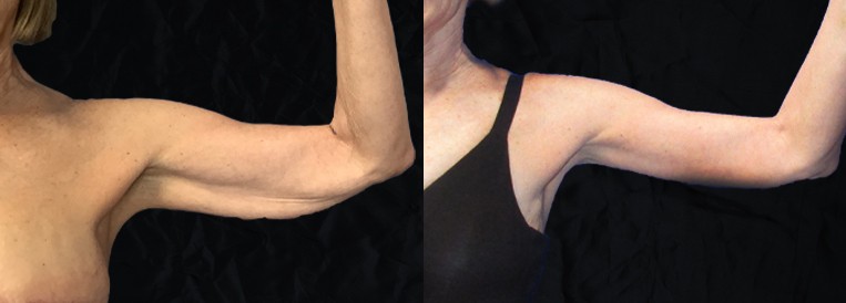 beforenafter pt6604 Breast Augmentation Scottsdale