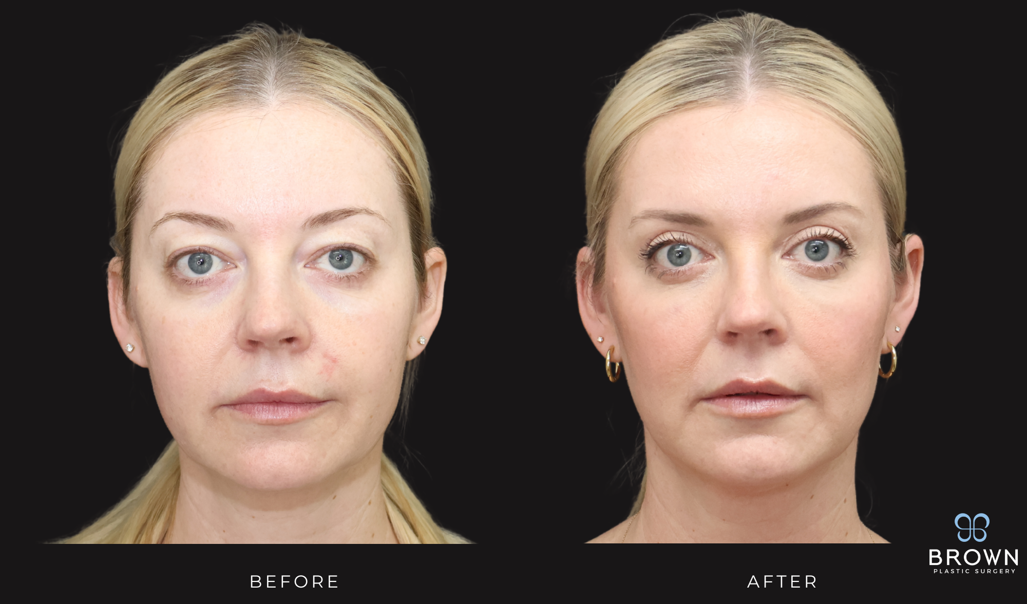 scottsdale upper bleph before and after dr. brown