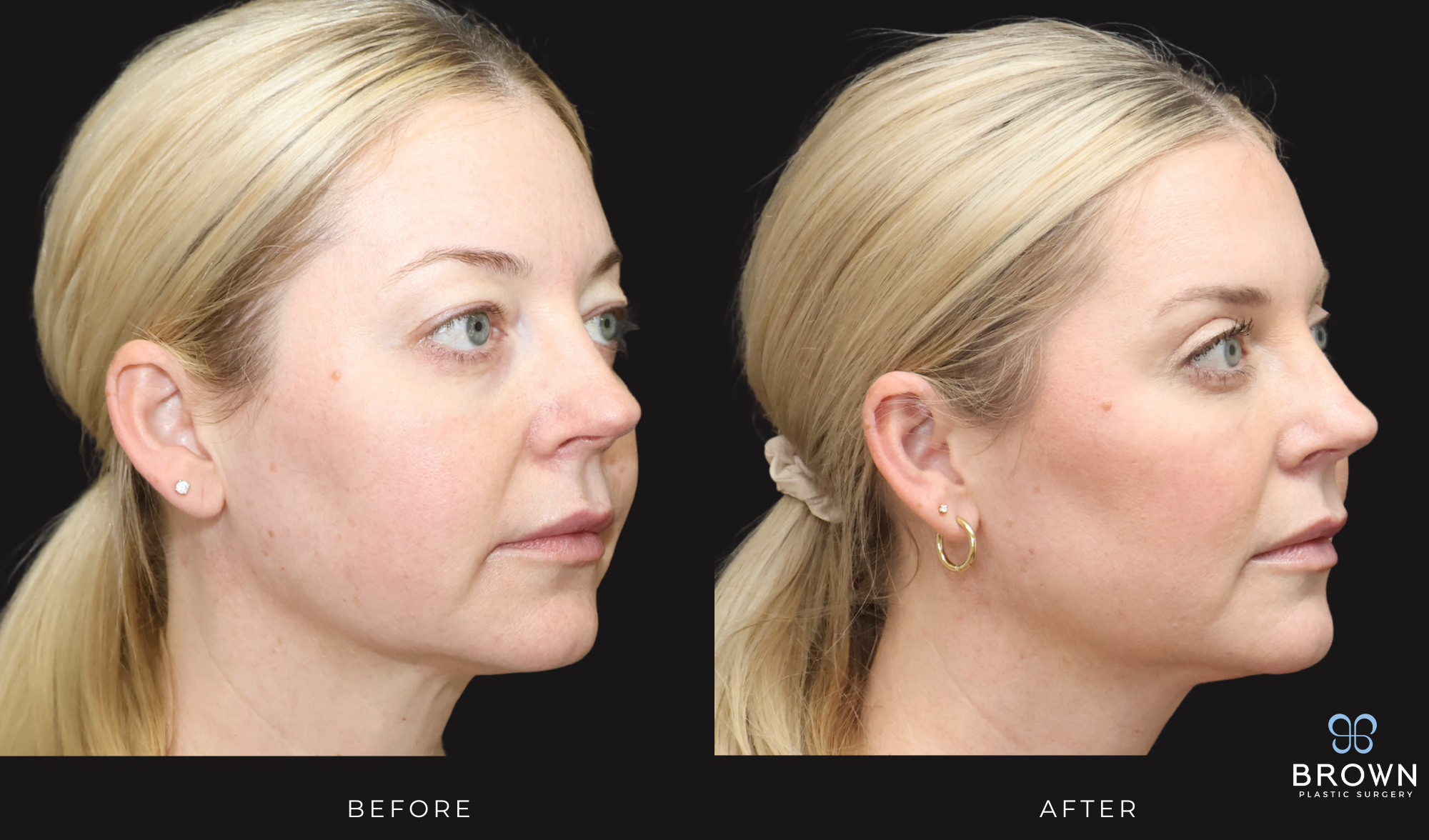 scottsdale upper bleph before and after dr. brown