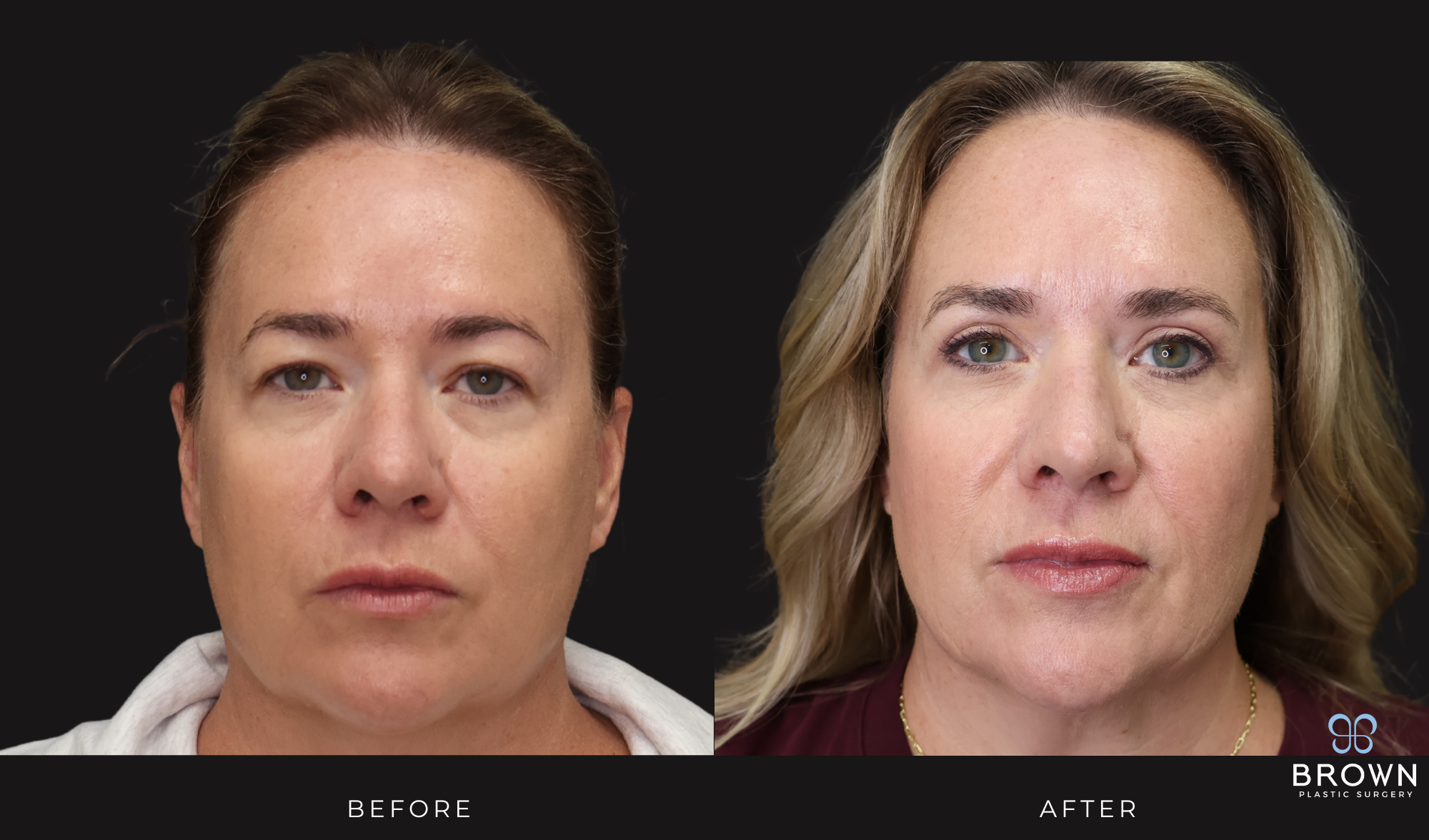 scottsdale upper bleph before and after dr. brown