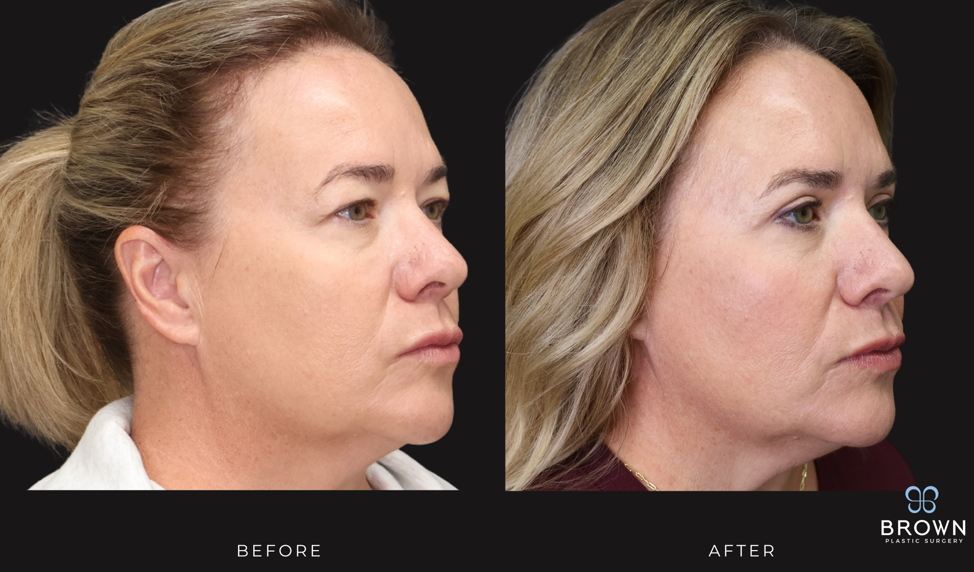 scottsdale upper bleph before and after dr. brown
