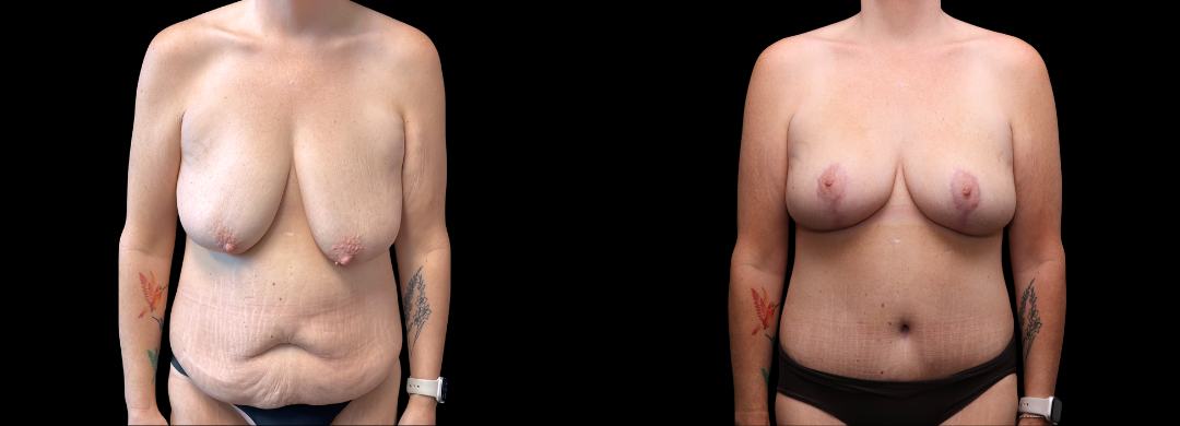 Me Again Makeover Patient 53 Me Again Makeover Patient 53