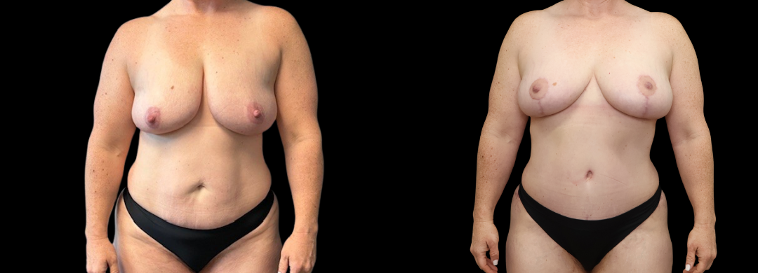 Me Again Makeover Patient 55 Me Again Makeover Patient 55