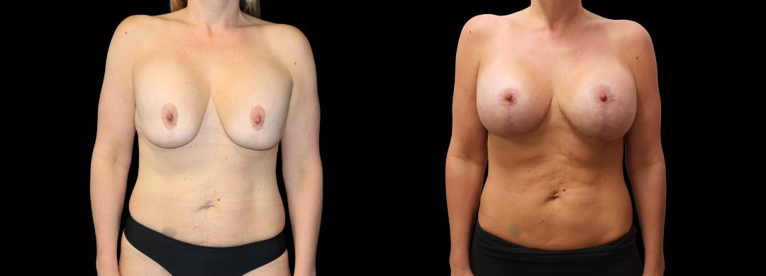 Me Again Makeover Patient 57 Me Again Makeover Patient 57