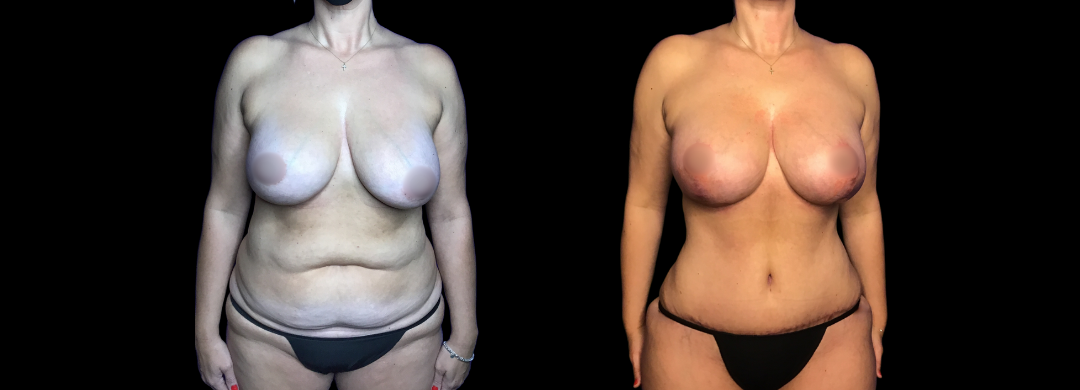 Me Again Makeover Patient 62 Me Again Makeover Patient 62