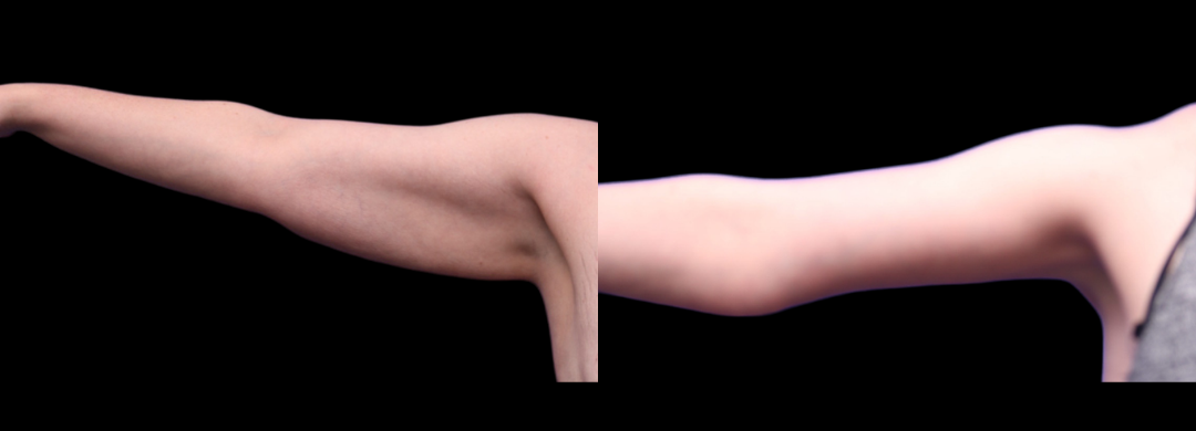 Brachioplasty Arm Lift 83