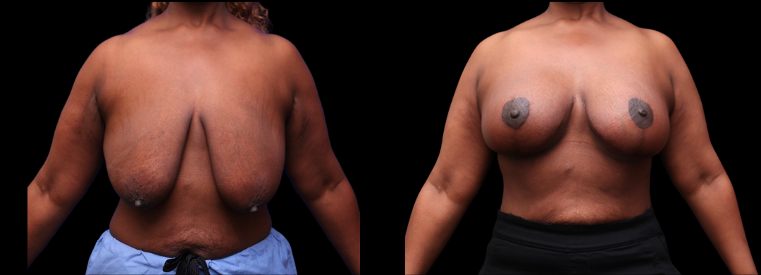 Breast Aug Mastopexy 28 Breast Augmentation Scottsdale