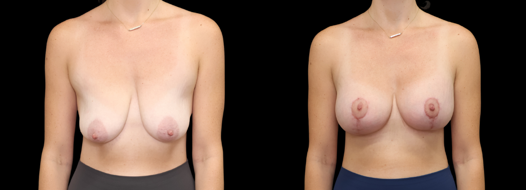 Breast Aug Mastopexy 42 Breast Augmentation Scottsdale