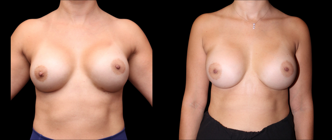 Breast Exchange Lift 16 Breast Augmentation Scottsdale