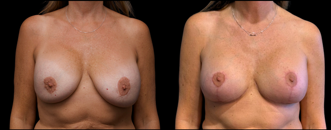 Breast Exchange Lift 3 Breast Augmentation Scottsdale