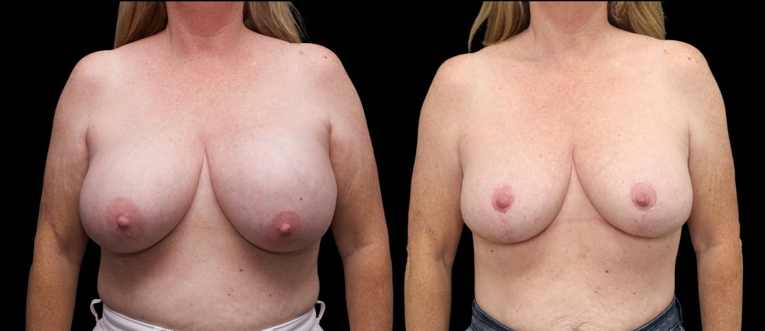 Breast Exchange Lift 7 Breast Augmentation Scottsdale