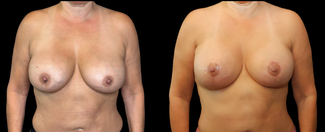 Breast Exchange Lift 8 Breast Augmentation Scottsdale
