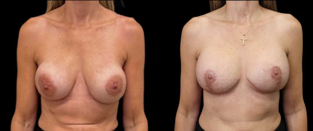 Breast Exchange Lift 9 Breast Augmentation Scottsdale