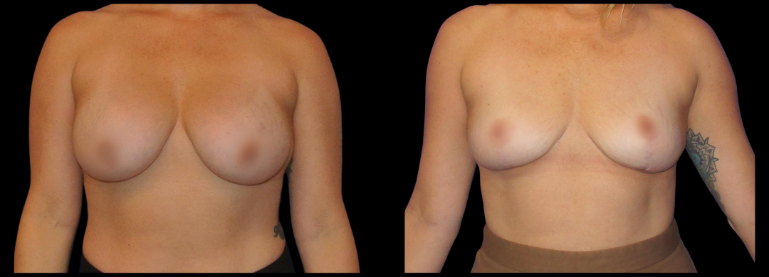 Breast Reduction Mastopexy 43 Breast Augmentation Scottsdale