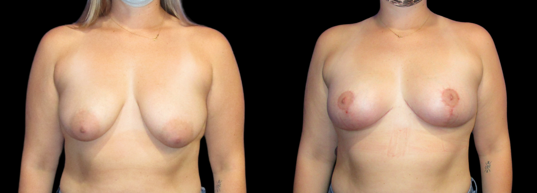 Breast Reduction Mastopexy 45 Breast Augmentation Scottsdale