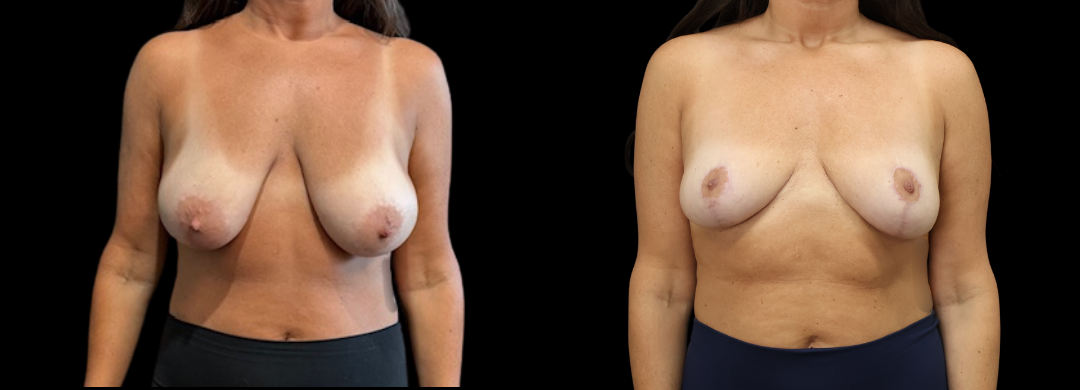 Breast Reduction Mastopexy 49 Breast Augmentation Scottsdale