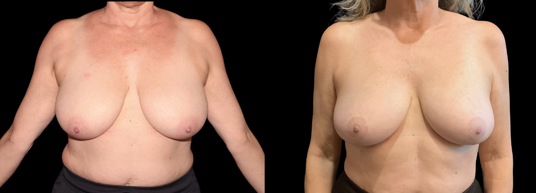 Breast Reduction Mastopexy 50 Breast Augmentation Scottsdale